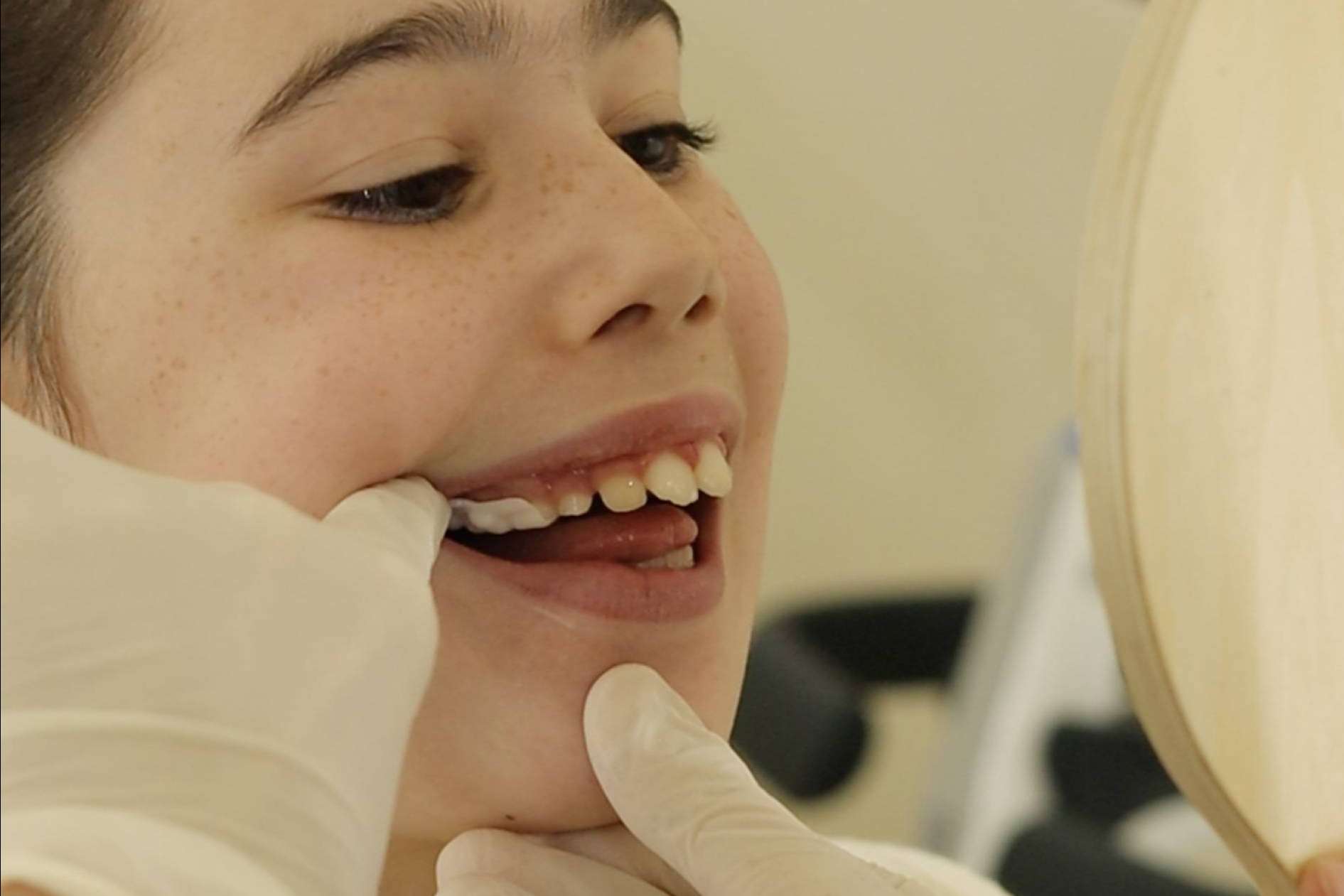 Smart Aligner Services welcomes the Palatal Expander at their 'Dental and Skeletal Expansion' event